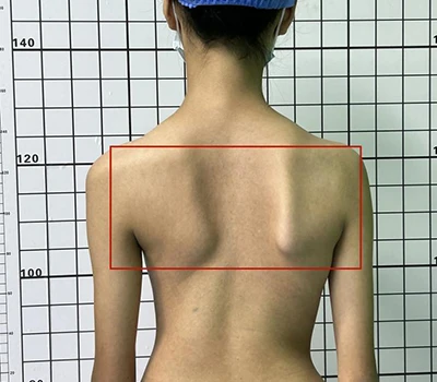 Kev ntsuam xyuas Scoliosis Comprehensive: Nkag siab, txheeb xyuas, thiab Hais Txog Kev Noj Qab Ha...