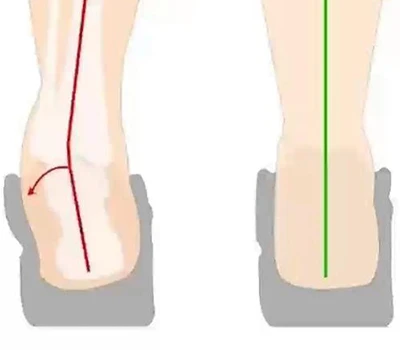Heel Eversion thiab Heel Inversion Assessment: Kev soj ntsuam kuaj mob, kev siv tswv yim, thiab k...