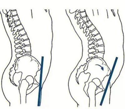 Kev Ntsuas Pelvic Tilt Assessment: Ua rau, Risks, Kev Ntsuas Kev Ntsuas, thiab Kev Siv Ua Lag Luam