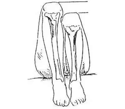 Leg Length Discrepancy (LLD) Kev Ntsuam Xyuas: Phau Ntawv Qhia Txog Kev Noj Qab Haus Huv, Kev Ua ...