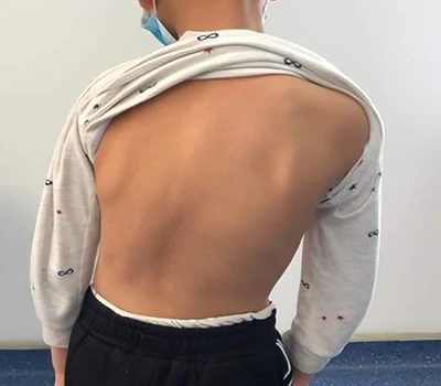 Scoliosis Kev Ntsuam Xyuas thiab Kev Tswj Xyuas: Yuav ua li cas Xianku 3D Lub Cev Scanner Pab Tus...