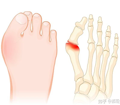 Hallux Valgus: Phau Ntawv Qhia Kev Tshawb Fawb Ua tiav