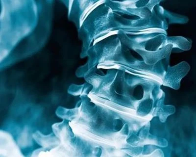 AI Scoliosis Screening Thiab Spinal Alignment Tracking: A Smarter 3D Health Screening Solution Ra...