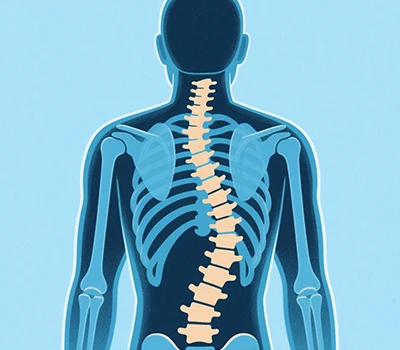 Scoliosis: Xianku 3D lub cev Scanner, 3D + AI, tiv thaiv scoliosis tiv thaiv thiab kev kho