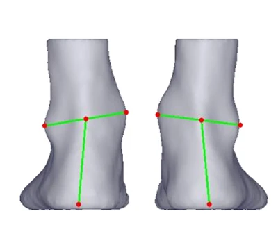 Heel Valgus thiab Varus: ib qho kev hem thawj ntsiag to hla