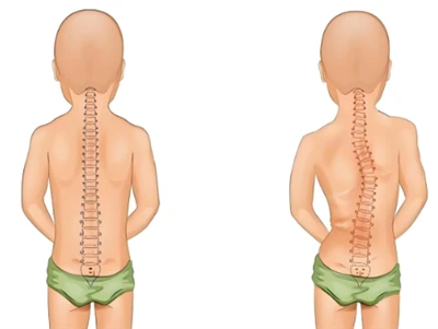 Txuj Ci Tshiab Scoliosis Kev Ntsuam Xyuas: AI & 3D Digital Spine