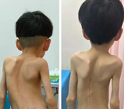 Spinal Health: Lub luag haujlwm ntawm 3D lub cev luam tawm thev naus laus zis hauv Scoliosis Kev ...