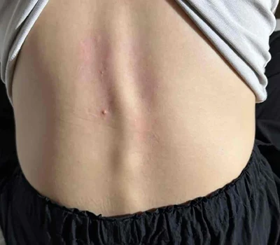 Kev tsom xam dav ntawm Scoliosis: Nkag siab txog cov xwm txheej thiab thev naus laus zis tsim taw...