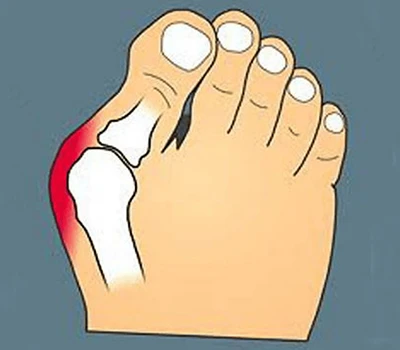Transforming Bunion Care: Ua kom muaj kev sib xyaw ua kom haum rau kev sib txuas lus, tus neeg mo...